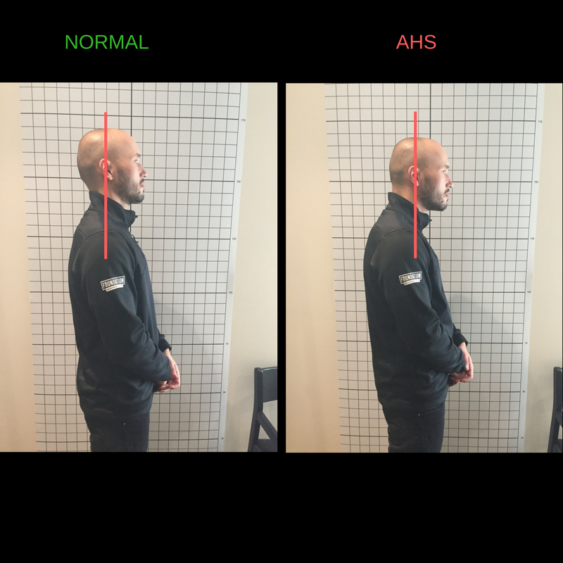 Ideally, the ear will line up with the middle of the shoulder. In Anterior Head Syndrome, the head falls forward and causes the ear to line up with the front of the shoulder and sometimes the chest.