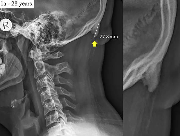 Photo Credit: http://fortune.com/2019/06/20/horns-growing-human-skulls-cell-phones/
