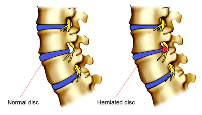 Disc Herniation and Nerve Pressurehttps://khanhtrinhvn.com/wp-content/uploads/2015/02/herniated-disc-700x400.jpg