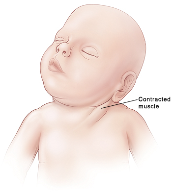 Torticollis - SCM contraction, head tilt, head rotationhttps://www.childrensmn.org/assets/img/prob_torticollis.jpg