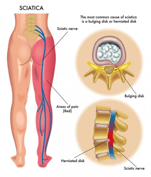 Sciatica Oakville Chiropractic