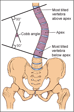 scoliosis-chiropractor-toronto.gif