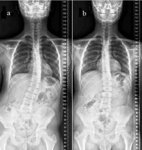 https://www.researchgate.net/figure/Figure--A-B-Anteroposterior-scoliosis-x-rays-before-treatment-shows-thoracic-scoliosis_fig1_299531476